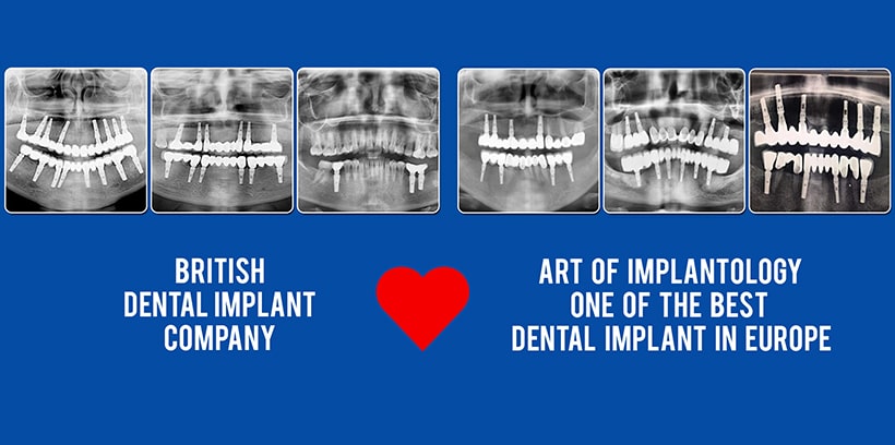 SOLVO UK IMPLANTS - World Wide Distrubutor