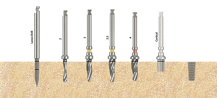 SLV Implants Systems- Premium Standard Implant Cap 4 Implant