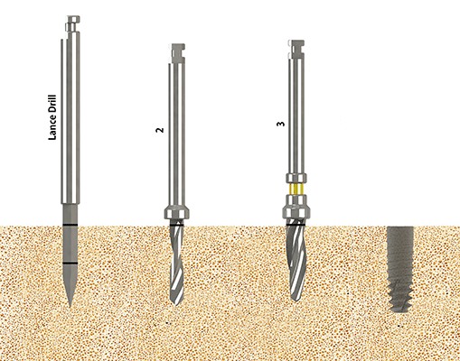 SLV Implants Systems- Premium Ultra Mini Implant